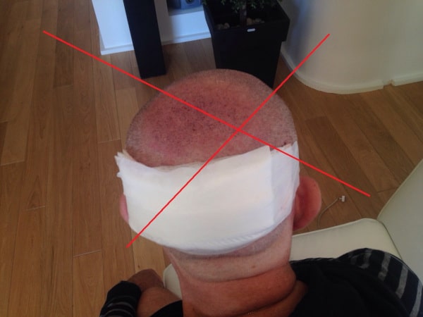 Trapianto di capelli con rapido recupero – Hasci Italia