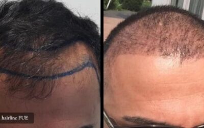 Trapianto di capelli HST : Risultato effetto naturale – Hasci Italia