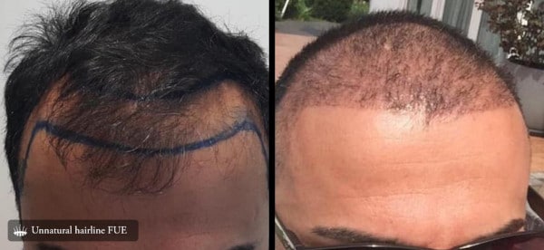 Trapianto di capelli HST : Risultato effetto naturale – Hasci Italia