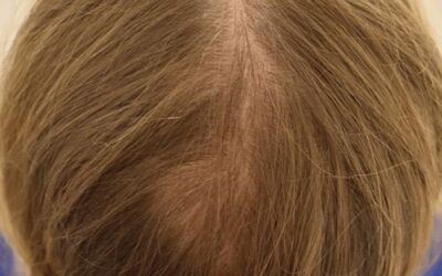 In Vivo Hair Multiplication: Patented Method – Hasci Swiss