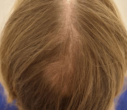 In Vivo Hair Multiplication: Patented Method – Hasci Swiss