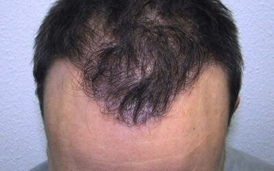 La ricrescita dei capelli : la crescita in condizioni normali – Hasci Italia