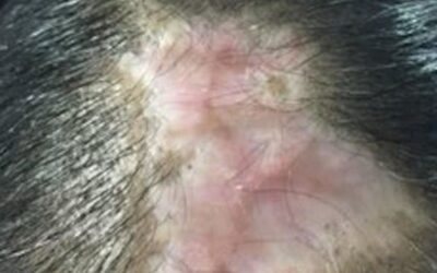 Trapianto capelli Turchia funziona? – Hasci Italia