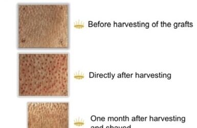 Male Baldness: HST Hair Transplant with Hair Multiplication – Hasci Swiss