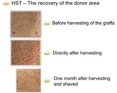 Male Baldness: HST Hair Transplant with Hair Multiplication – Hasci Swiss