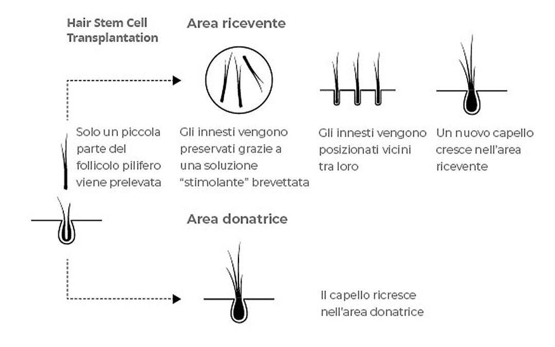 Stem Cells in Hair Transplantation – Hasci Swiss