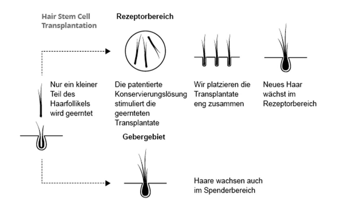 HST Technik: Vorteile der Haarstammzelltransplantation – Hasci Swiss
