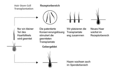 HST Technik: Vorteile der Haarstammzelltransplantation – Hasci Swiss