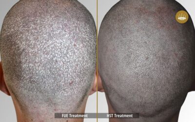 Risks of FUE Hair Transplants and Androgenetic Alopecia – Hasci Swiss