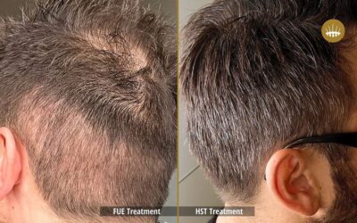 Human Follicular Unit Evolution – Hasci Swiss