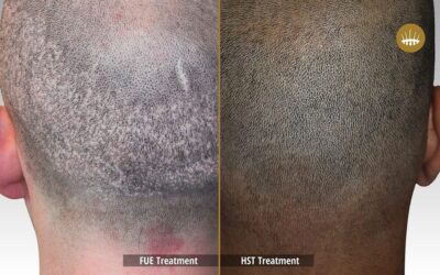 Hair Stem Cell Transplantation : Outstanding Results – Hasci Italia