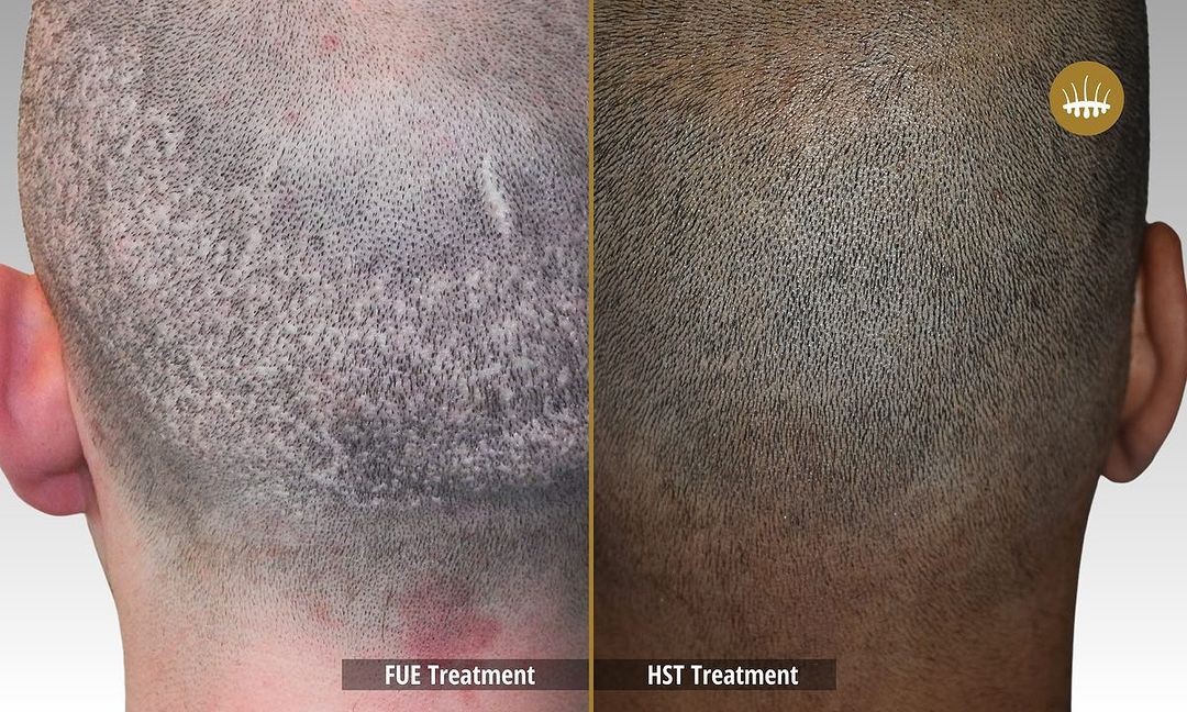 Migliore clinica : Tecnica esclusiva trapianto – Hasci Italia