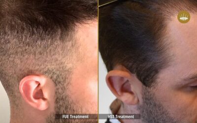 Transplantation capillaire : Comparaison FUE et HST – Hasci Swiss