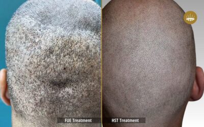 Risks of FUE Hair Transplants and Androgenetic Alopecia – Hasci Italia