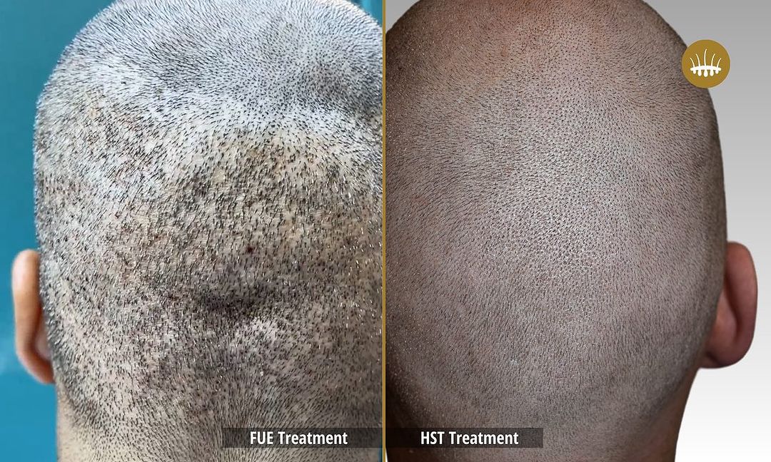 Risques et implications de l&rsquo;autotransplantation FUE – Hasci Swiss