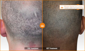 FUE vs HST - Donor Area - After 9 months