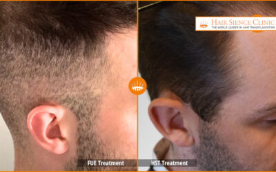 HST Hair Stem Cell Transplantation vs FUE – Hasci Swiss