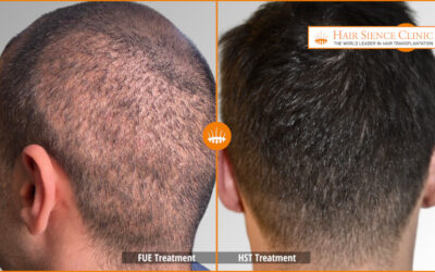 Can I Have Another Hair Transplant After FUE? Repair with HST/PL‑FUT