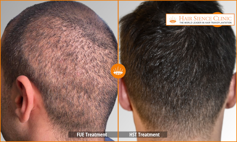 Can I Have Another Hair Transplant After FUE? Repair with HST/PL‑FUT