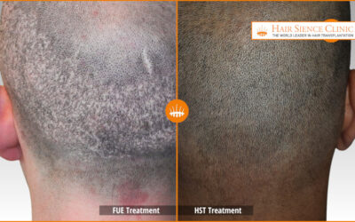 FUE vs HST: Which Hair Transplant Technique Should You Choose?