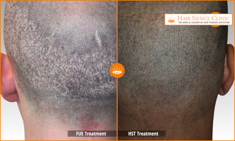 FUE vs HST: Which Hair Transplant Technique Should You Choose?