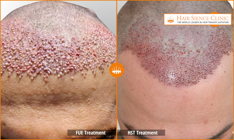 FUE vs HST - Receving Area - After 0 day