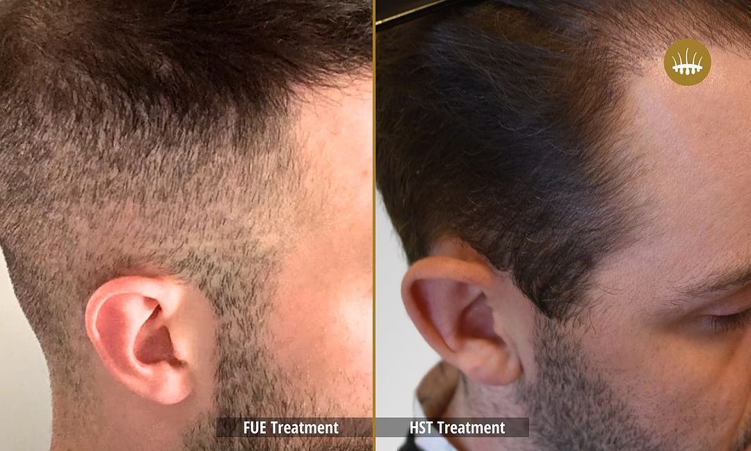 Transplantation capillaire : Comparaison FUE et HST – Hasci Swiss