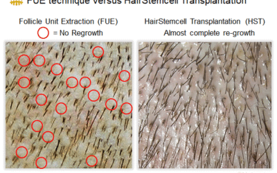 Low-Cost FUE Medical Tourism for Hair Transplantation – Hasci Swiss