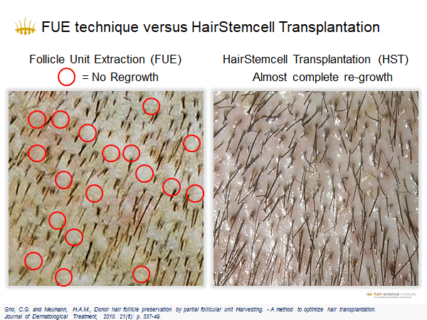Low-Cost FUE Medical Tourism for Hair Transplantation – Hasci Swiss