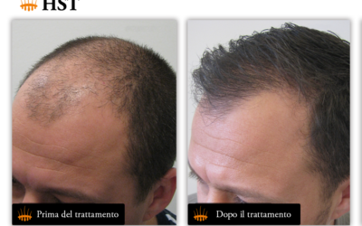 Revolutionizing Alopecia Treatment: The Promise of HST – Hasci Swiss