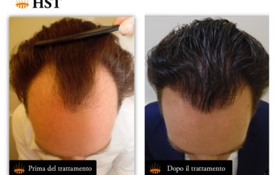 Benefits of HST Hair Stem Cell Transplantation – Hasci Swiss