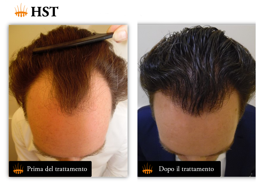 Vantaggi del Trapianto con Tecnica HST – Hasci Italia