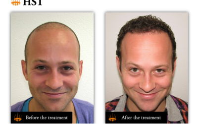 Stem cell cloning in transplantation at HAIR STEM CELL CLINIC – Hasci Italia