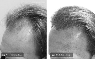 Prima e dopo trapianto capelli : Risultati – Hasci Italia