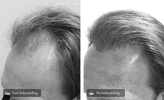 Prima e dopo trapianto capelli : Risultati – Hasci Italia