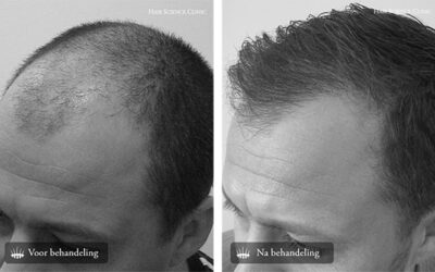 The procedure for performing HST hair transplants.