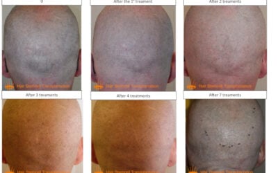 Natural and invisible hair transplant: the HST approach
