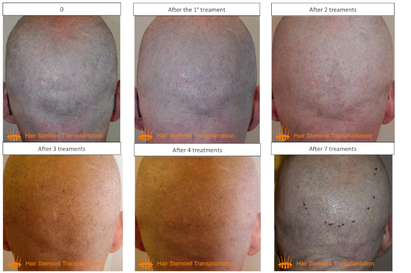 Natural and invisible hair transplant: the HST approach
