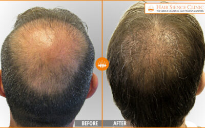 Hair Transplant with Limited Donor Area: Options with HST/PL‑FUT
