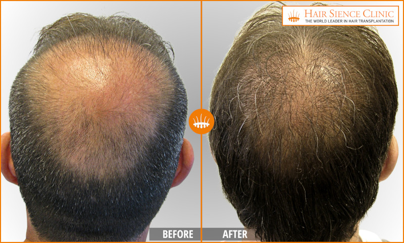 Hair Transplant with Limited Donor Area: Options with HST/PL‑FUT
