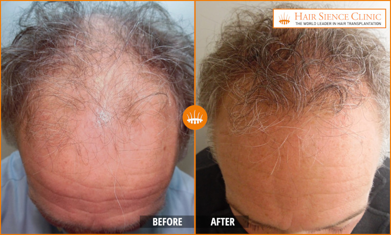 HST - Men - Before After (6)