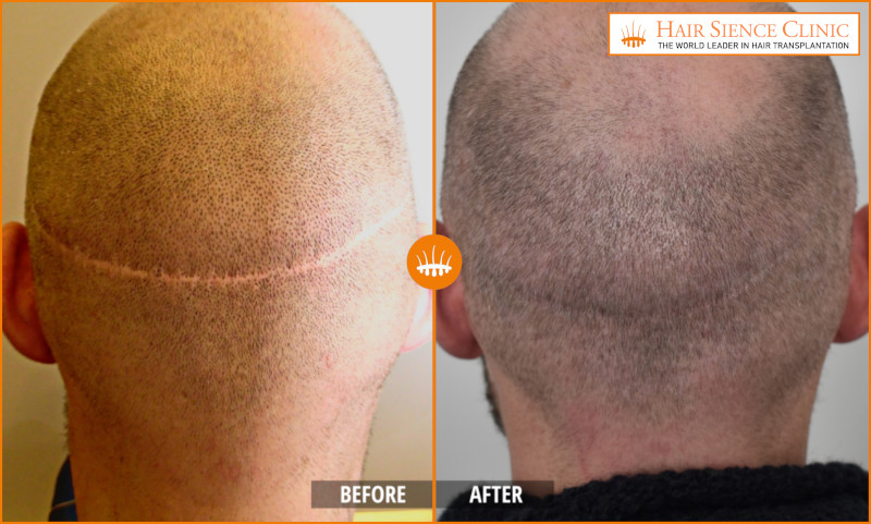 HST - Men - Before After Scars
