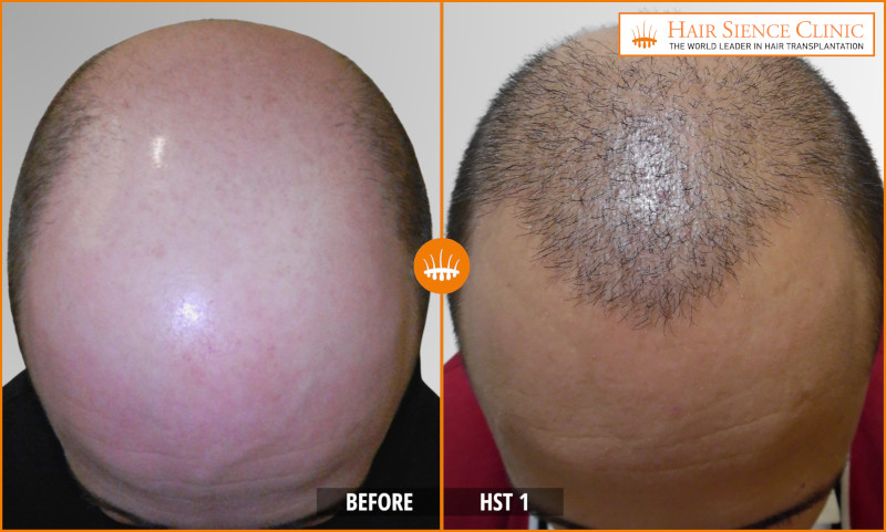 HST - Men - Before After