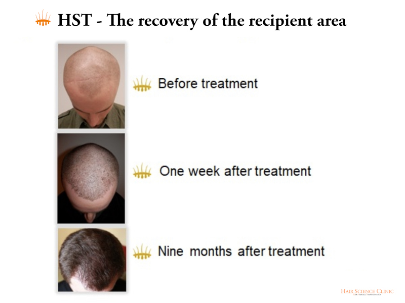 HST - The recovery of the recipient area