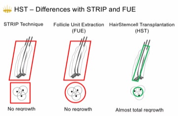 HST Hair Stem Cell Transplant vs Low-Cost FUE and FUT Procedures – Hasci Swiss