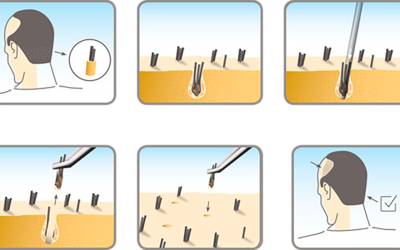 Your hair will grow back using the HST method