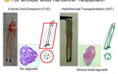 Hair Stem Cell Transplantation (HST/PL‑FUT): How It Works