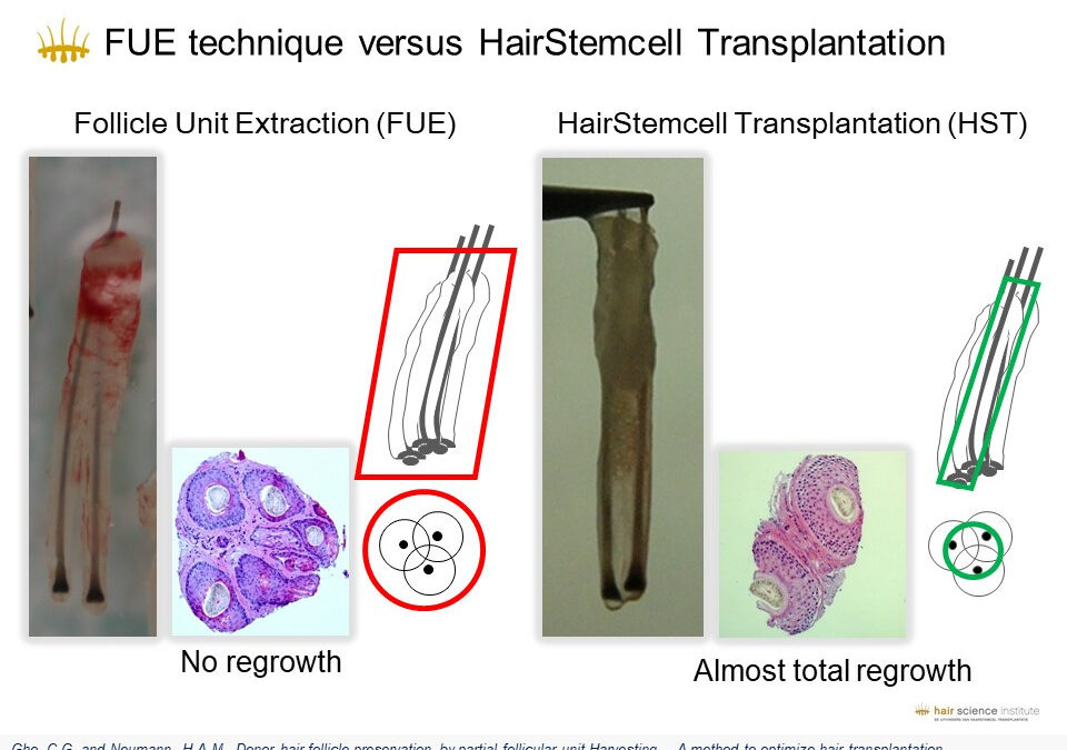 Hair Stem Cell Transplantation (HST/PL‑FUT): How It Works