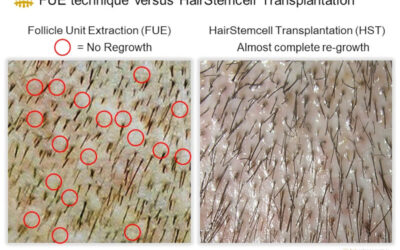 Scarless Hair Transplant: Is It Really Possible? The HST/PL‑FUT Advantage