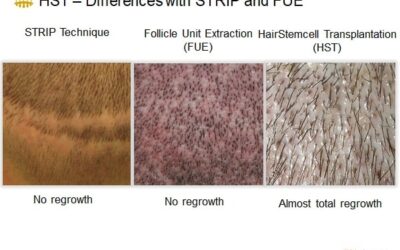 Hair Transplant: Disappointment and Why – Hasci Swiss